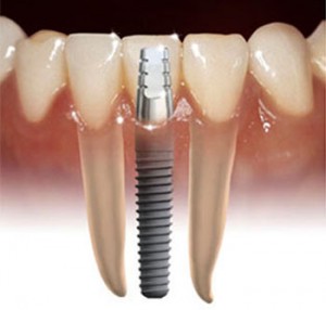Dental implants Weatherford TX