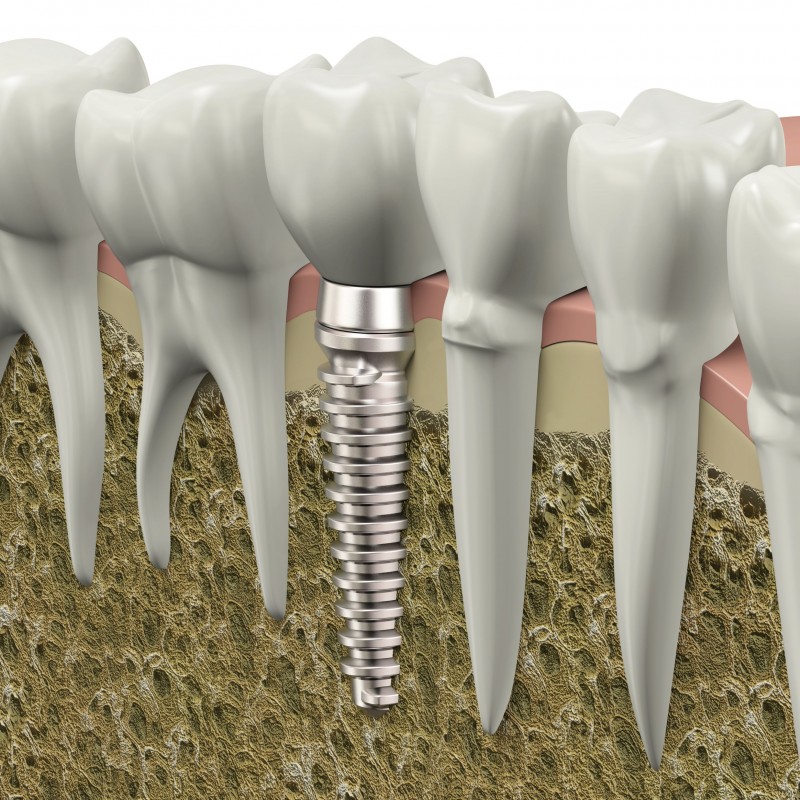 Dental Implants Dentures In Panama City FL Are Convenient And Affordable