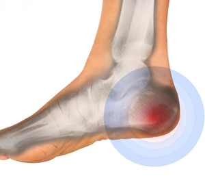 What to Know About Heel Pain Treatment in Kenosha, WI