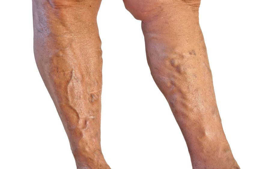 What is endovenous laser treatment for varicose veins?